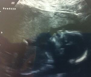 Ella in ultrasound at 20 weeks